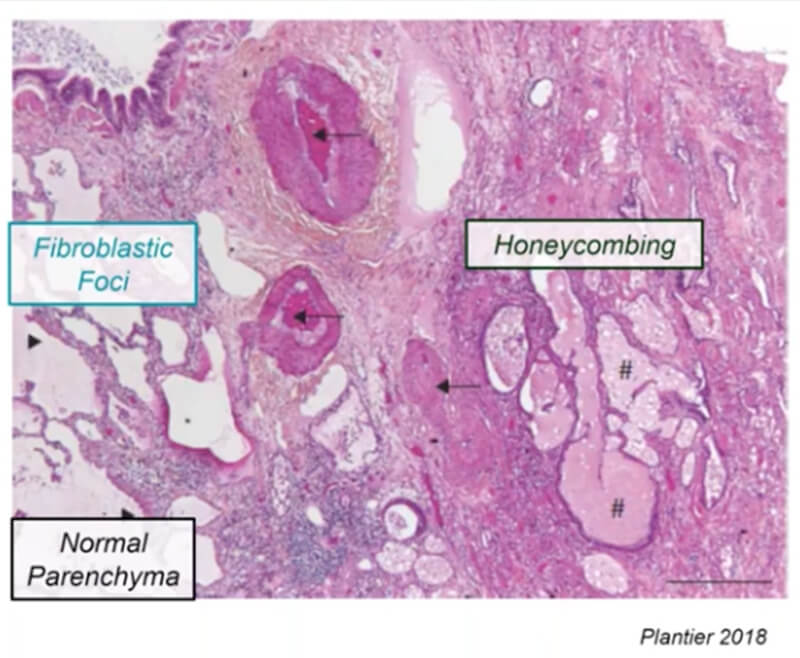 Histological image simulated with DILIsym textures: "Fibroblastic Foci," "Honeycombing," "Normal Parenchyma.